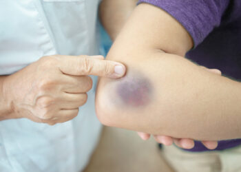 What does it mean when you bruise easily?