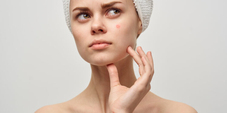 Does toothpaste really clear up pimples?